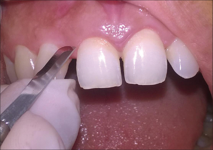 pinpoint to interdental site for Modified papilla preservation technique incision