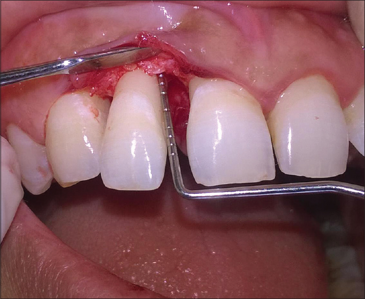 Open flap debridement